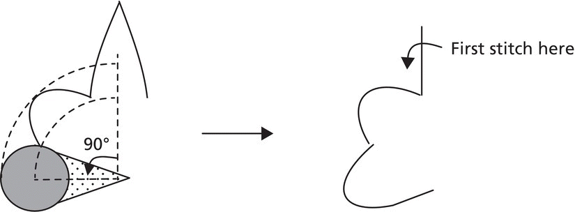 Schematic depicting Zitelli modified bilobe flap, displaying a circle, a cone shape and a wave with arrow for angle of 90° (left), linked to an irregular wave with an arrow labeled “First stitch here” (right).