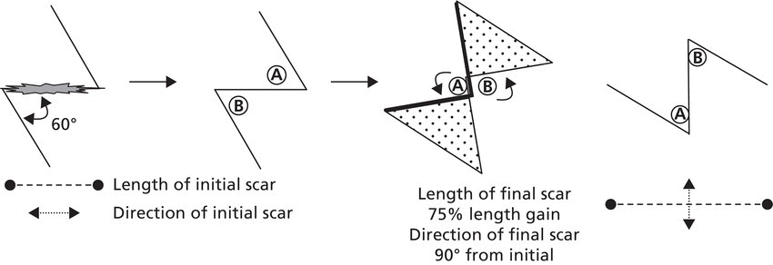 Schematic of Z-plasty, illustrated by 4 Z-shaped lines linked by arrows. A line segment and a double headed-arrow below depicts the length of initial scar and direction of initial scar, respectively.