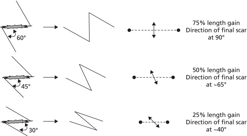 3 Schematics of Z-plasty depicting 75% length gain with direction of final scar at 90°, 50% length gain with direction of final scar at ~65°, and 25% length gain with direction of final scar at ~40° (top–bottom).