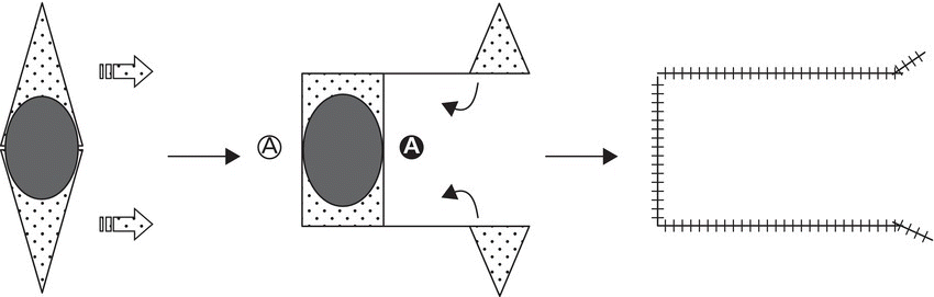 Schematic depicting U-plasty/0 to U: unilateral advancement, with arrows linking a diamond containing an ellipse, an irregular shape with an ellipse, and a rectangular shape with hatched lines, opened on the right side.