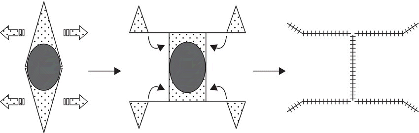 Schematic depicting H-plasty/0 to H: bilateral advancement, with arrows linking a diamond containing an ellipse, a box with an ellipse, and an I-shape with hatched lines.