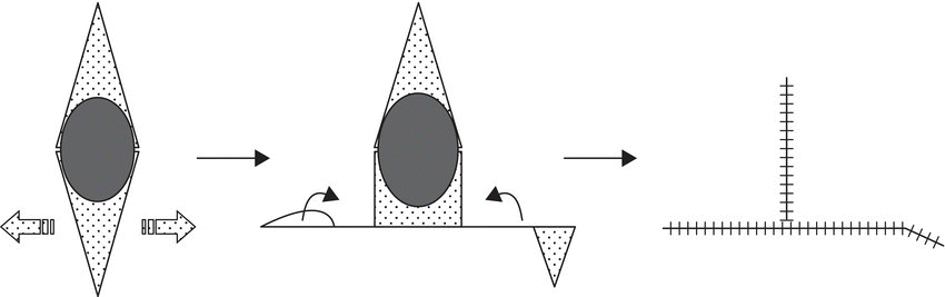 Schematic depicting Q→T/T-plasty/A→T: bilateral advancement, with a diamond shape with an ellipse linked by arrows to an irregular shape with an ellipse, then to 2 perpendicular lines with hatched lines.