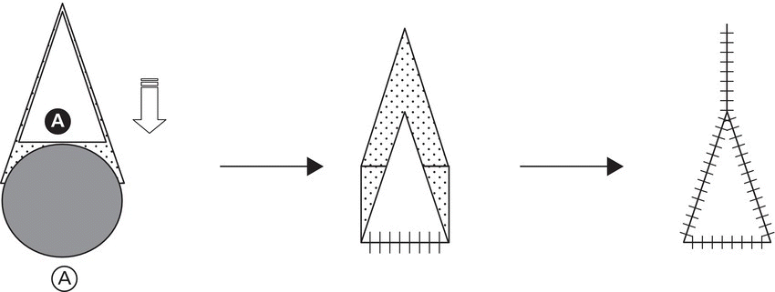 Schematic illustrating the V→Y advancement, island pedicle, and kite flap.