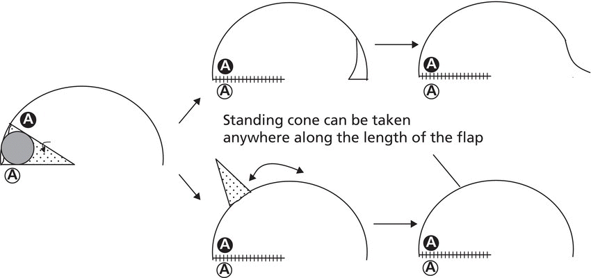 Schematic illustrating the process of unilateral rotation flap with the standing cone take anywhere along the length of the flap.