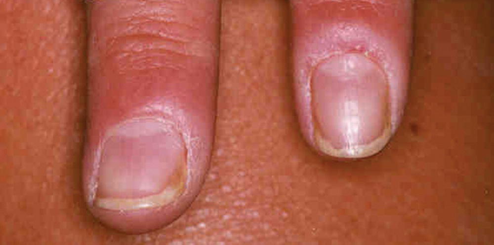 Schematic illustration of paronychia.