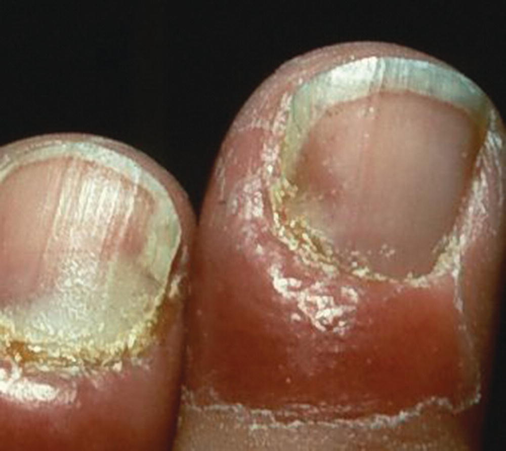Schematic illustration of infected nail.