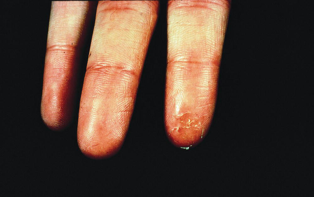 Schematic illustration of dermatitis on the finger.