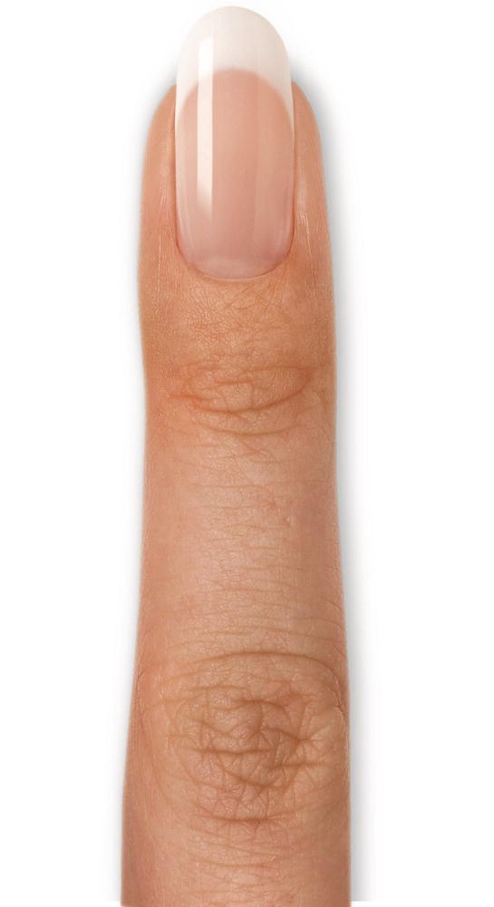 Schematic illustration of the use of custom-blended colored powders with methacrylate monomers to “illusion sculpt” and extend the apparent length of a short nail bed while also correcting a habitually splitting nail plate.