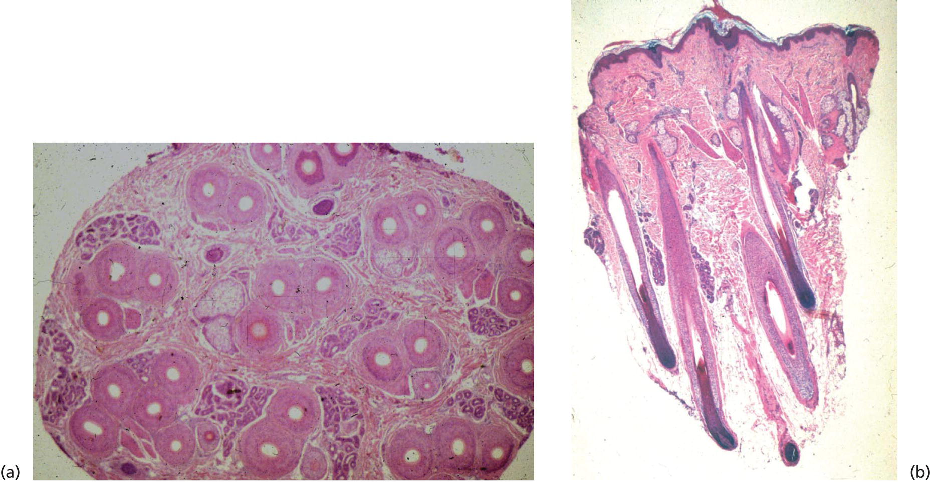 Schematic illustration of (a) Horizontal section of a 4 mm scalp biopsy specimen demonstrating follicular units containing 1, 2, 3, or 5 anagen follicles. (b) Vertical section of a 4-mm scalp punch biopsy specimen from a normal, healthy Caucasian female in her early 1920s demonstrating normal anagen follicles.