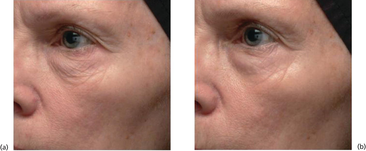 Schematic illustration of topical retinyl propionate (RP) reduces the appearance of fine lines/wrinkles.