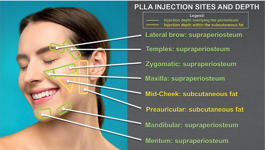 Schematic illustration of site-specific injectable poly-l-lactic acid (PLLA) map