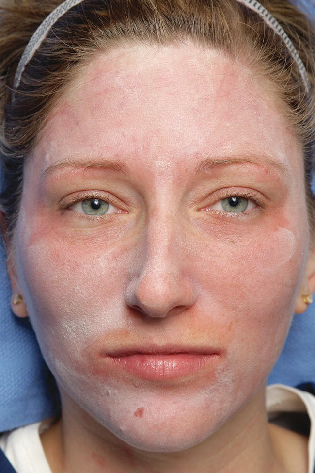 Schematic illustration of white discoloration of the skin seen during a salicylic acid peel caused by evaporation of the vehicle and precipitation of salicylate on the skin.