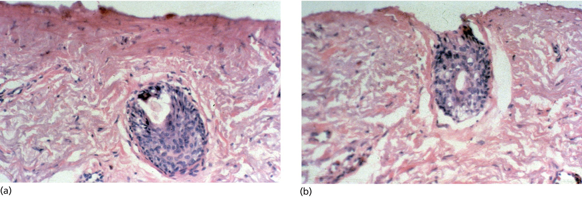 Schematic illustration of (a) Two passes of CO2 laser at 7 J/cm2 leaves approximately 70 μm of residual thermal necrosis. (b) Two passes of Er:YAG laser at 10 J/cm2 results in removal of approximately 50 μm of this necrotic tissue.
