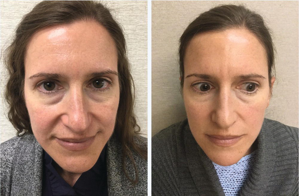 Schematic illustration of forty-four-year-old female before and after five treatments with intense pulse light for facial rejuvenation.