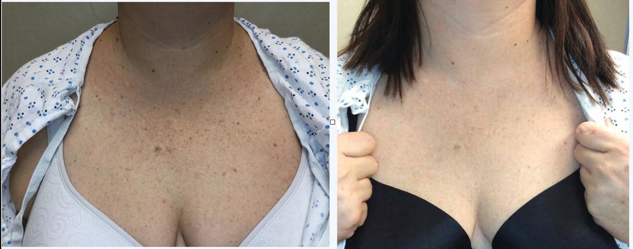 Schematic illustration of forty-five-year-old before and after two treatments of intense pulse light to the chest for dyschromia.