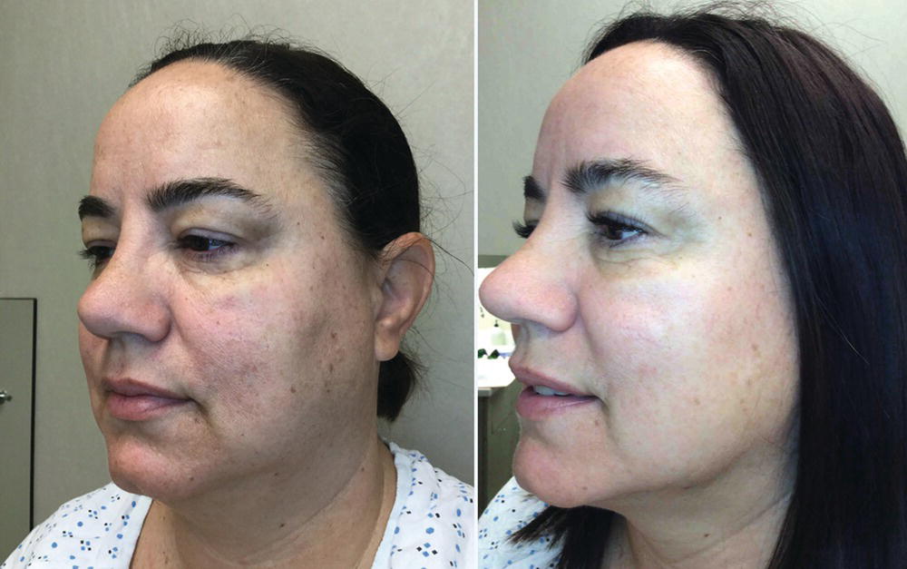 Schematic illustration of forty-five-year-old female before and after two treatments with intense pulse light to the face for rejuvenation.