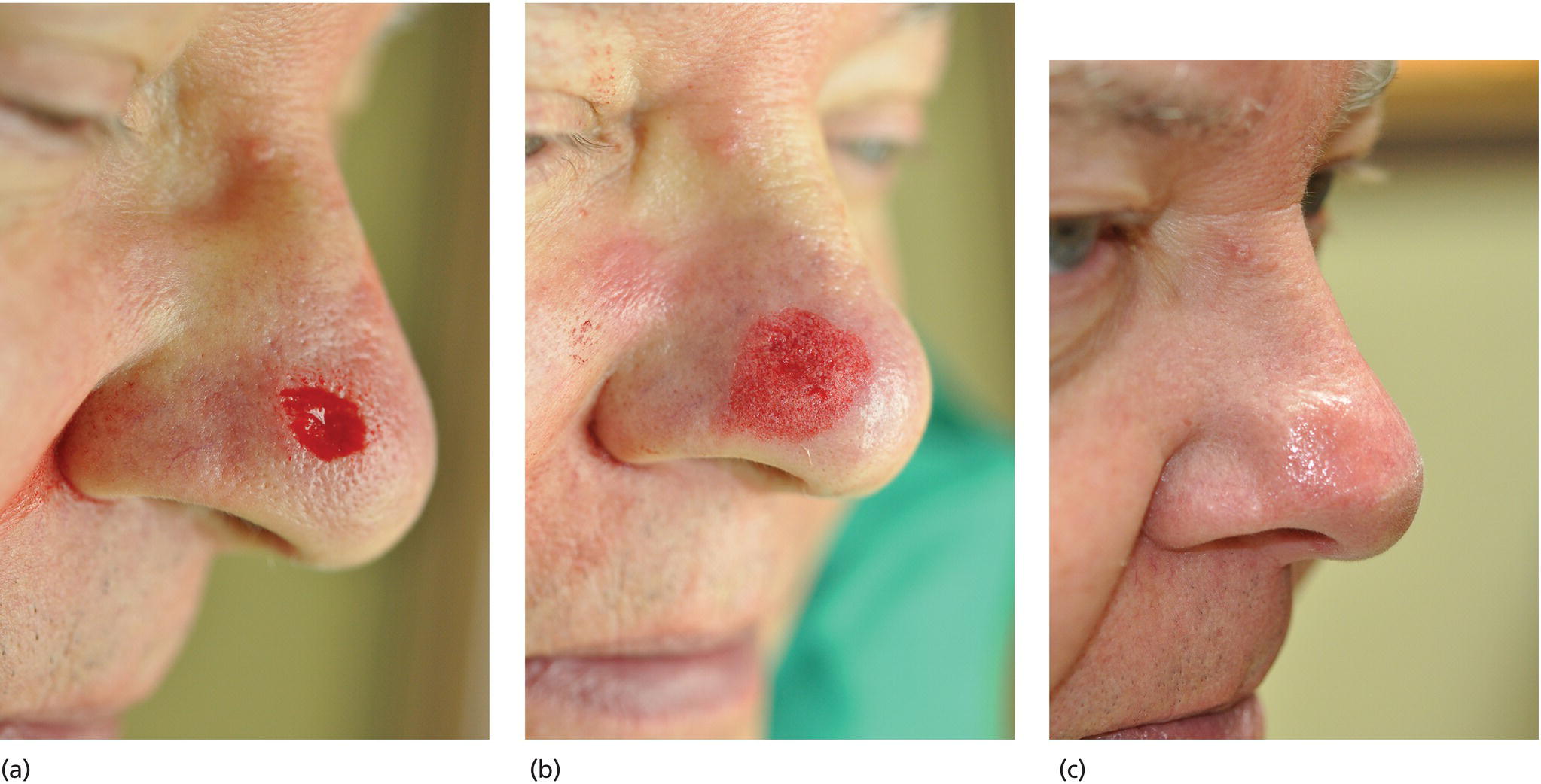 Schematic illustration of dermabrasion after partial-thickness Mohs layer on the nose.
