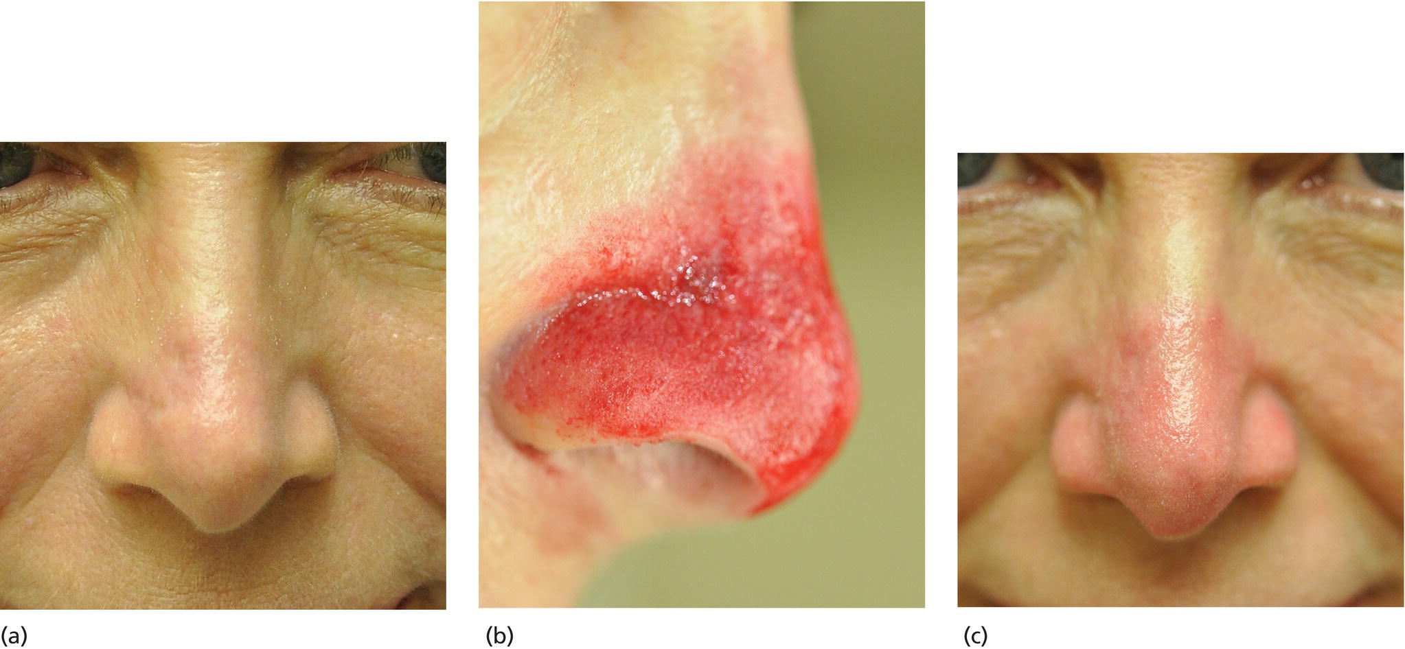 Schematic illustration of dermabrasion of scar on the nose after Mohs surgery and reconstruction.