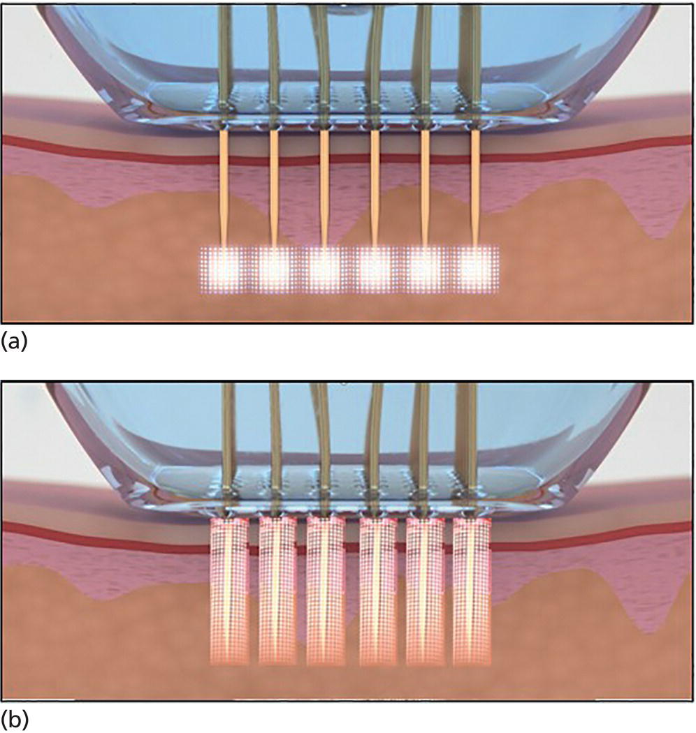 Schematic illustration of illustration of radiofrequency dispersion through microneedles: (a) illustration of insulated needle affect and (b) illustration of non-insulated needle affect.