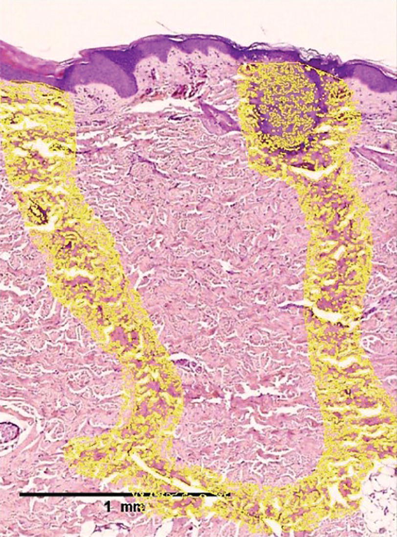 Schematic illustration of non-insulated RFMN effect showing needle to needle communication.