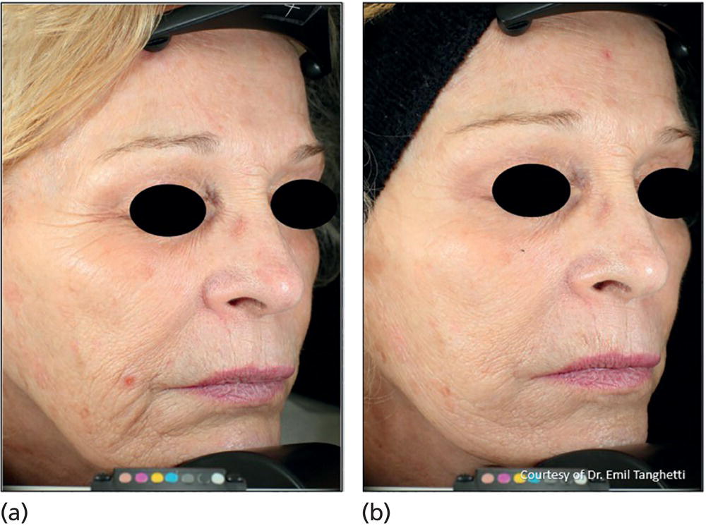 Schematic illustration of wrinkle reduction: (a) before and (b) after.
