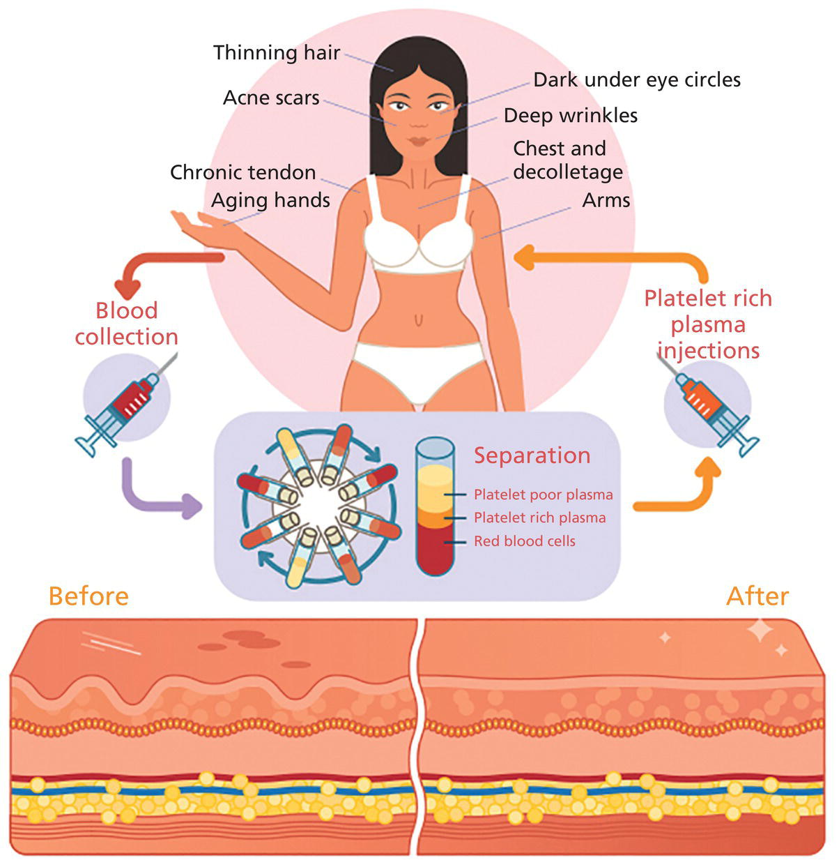 Schematic illustration of preparation of PRP clip art. The correct preparation of PRP is critical to ensure reliable and reproducible volume of PRP and adequate platelet numbers. Centrifuges and PRP collection kits are regulated by FDA as 501K medical devices.