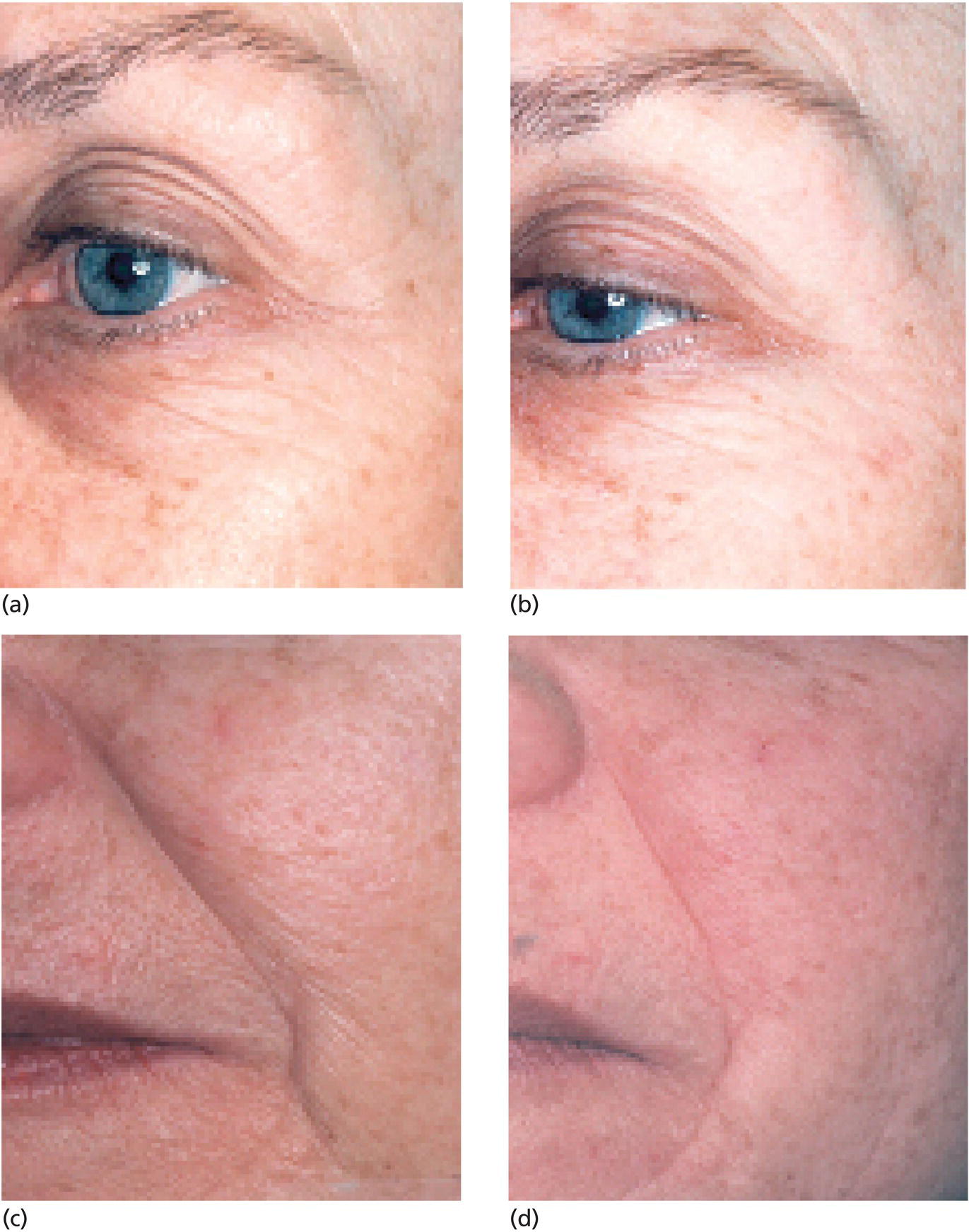 Schematic illustration of tiny wrinkles and crepey skin can be treated immediately at home by exfoliation. Improvement is seen in this 60-year-old woman’s face after she simply washed with a nonwoven polyester polishing pad and used a waxy exfoliant that mechanically “sticks” and removes surface cells. (a) and (c) Pre-exfoliation; (b) and (d), post-exfoliation.