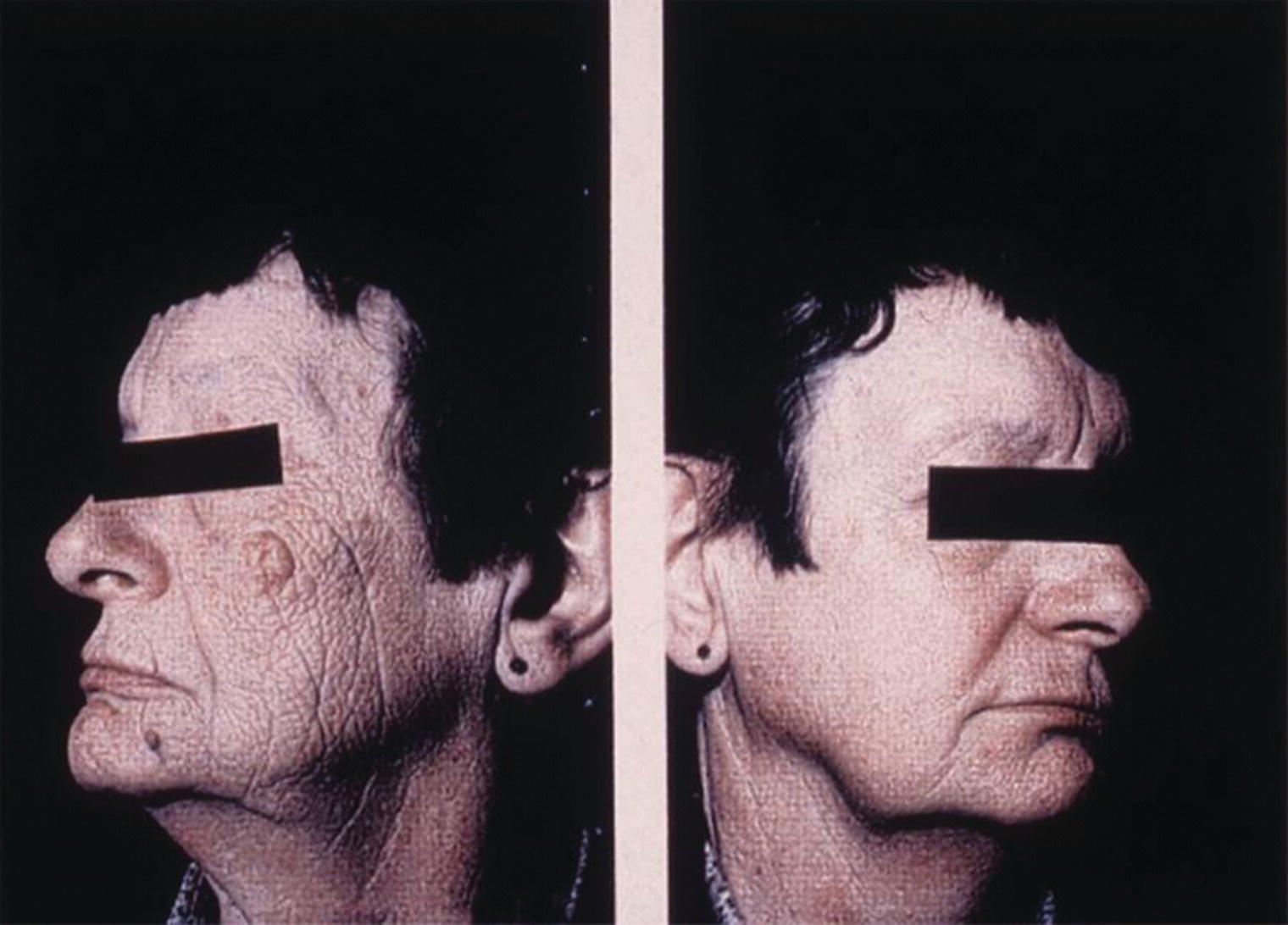 Schematic illustration of this secretary sat at the same desk for more than 30 years. Her left face which was exposed to UVA through the window shows severe photodamage, especially when compared with the less-exposed right side.