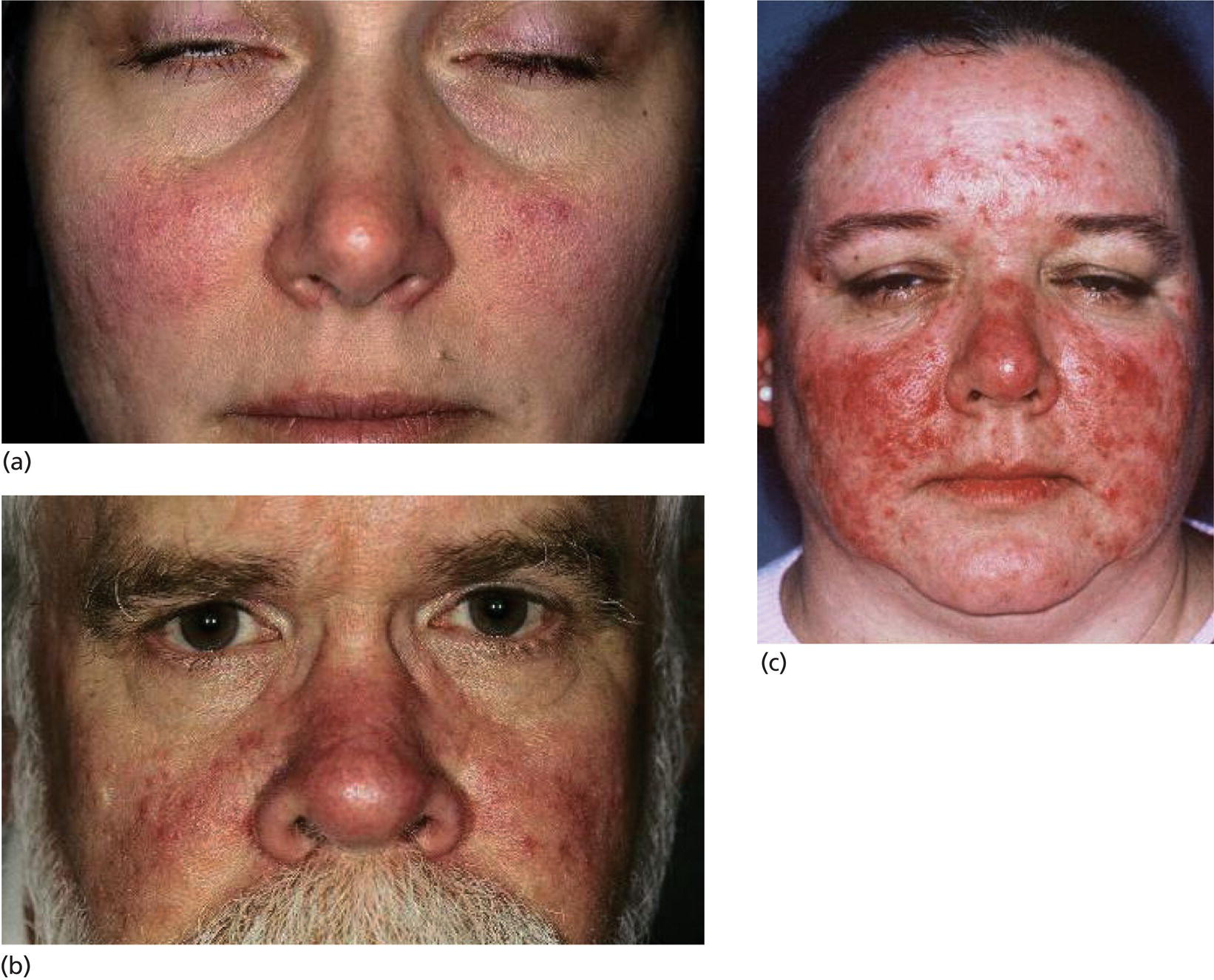 Schematic illustration of mild (a), moderate (b), and severe (c) rosacea.