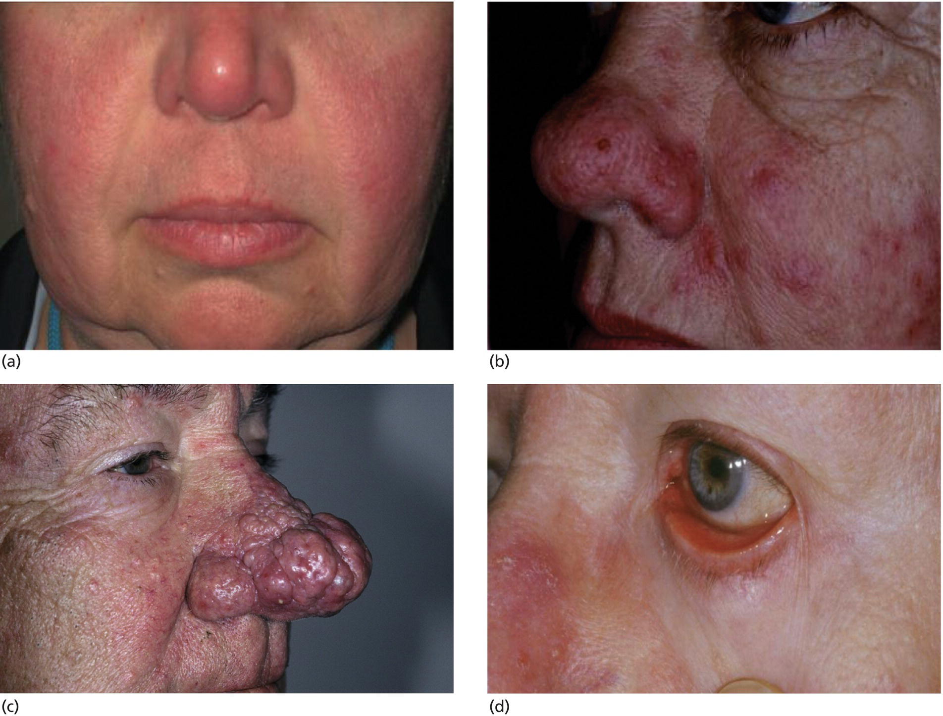 Schematic illustration of rosacea clinical subtypes: (a) subtype 1; (b) subtype 2; (c) subtype 3; (d) subtype 4.