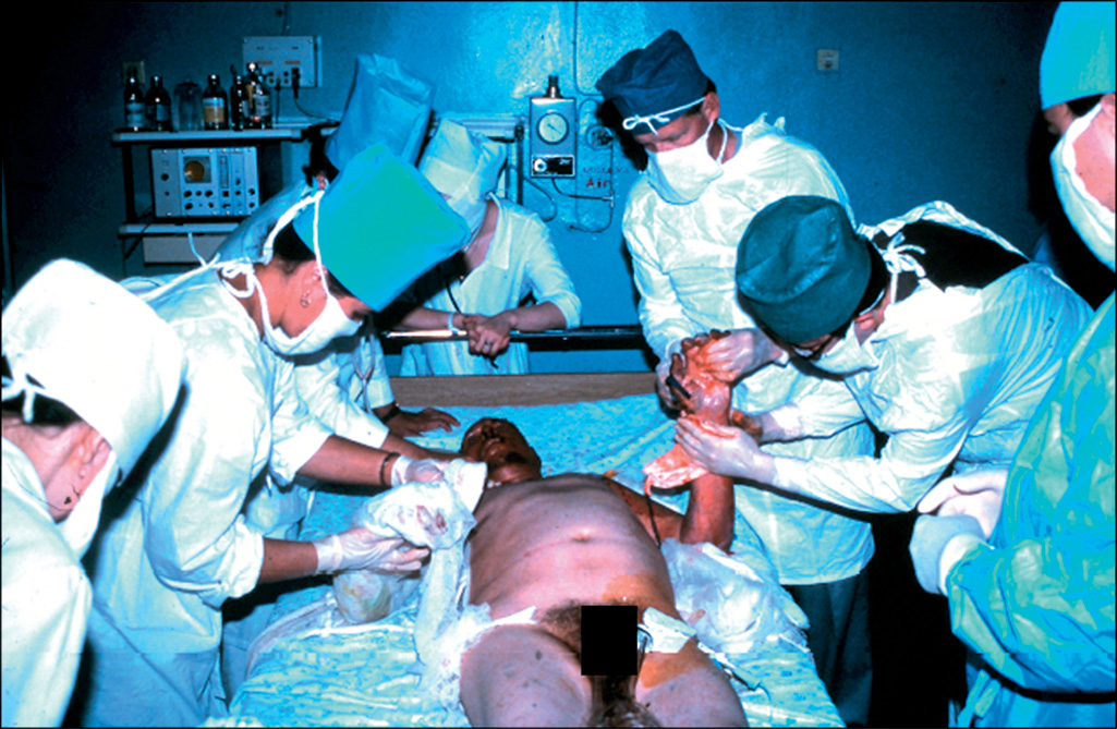 An operating room photo from Ufa, Russia, 1989, showing a joint U S and Russian surgical team performing burn wound care on a patient.