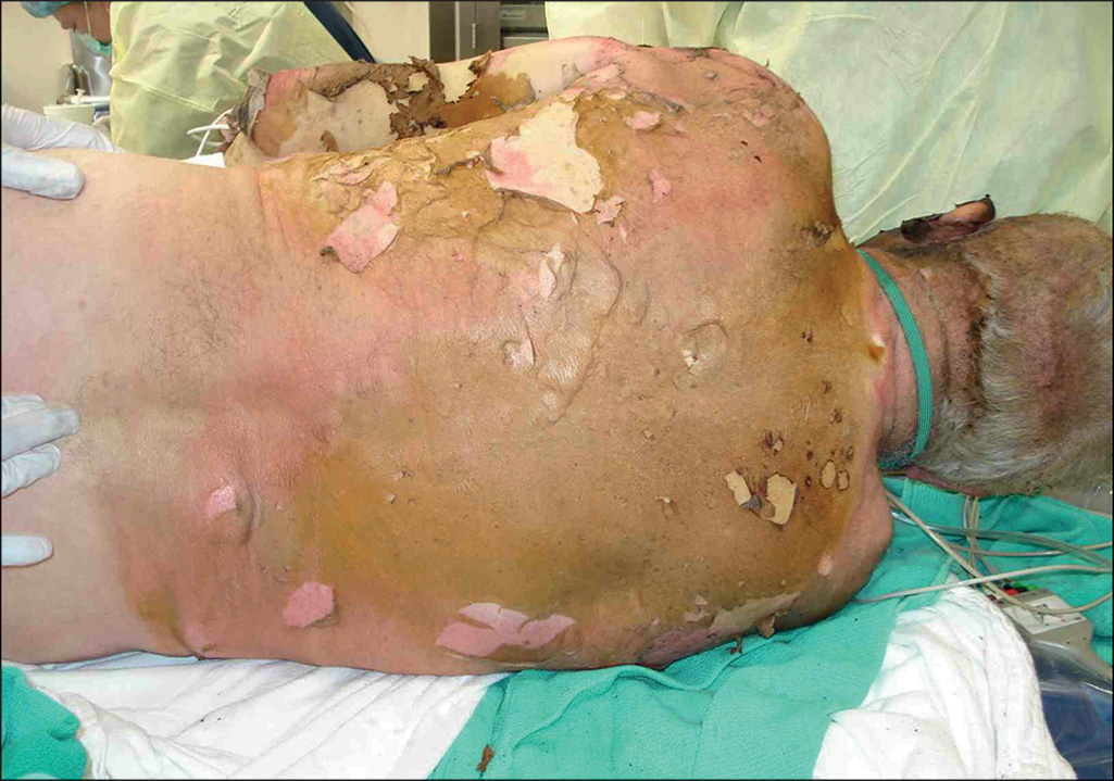 A photograph shows the back and torso of a patient with third-degree burns, displaying areas of skin loss and a leathery, discolored appearance. The photograph shows a severe third-degree burn affecting a patient's torso and upper body. The burned area displays the characteristic leathery, thick appearance typical of full-thickness burns, with visible areas of discoloration. The burn extends across the chest and appears to involve a significant body surface area. The patient is positioned on medical bedding with draping, and medical equipment is visible in the background.