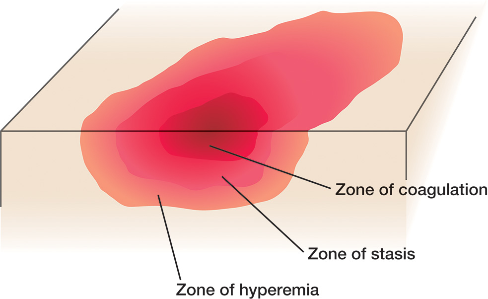 A diagram shows three concentric zones of burn injury with zone of coagulation at center, zone of stasis around it, and zone of hyperemia at outer edge.