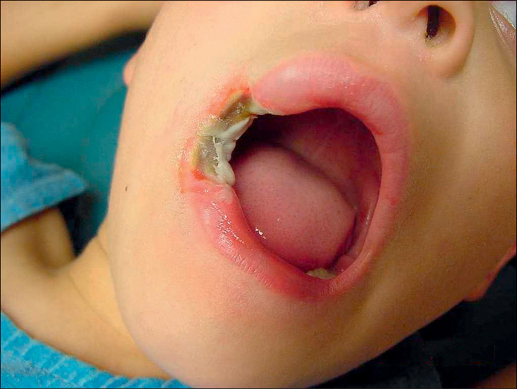 A photograph shows burn injury on the lips and perioral area of a pediatric patient with mouth open.