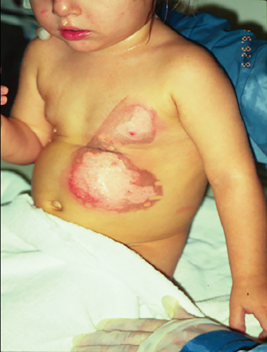 A photograph shows multiple full thickness contact burns with blisters on a pediatric chest, displaying triangular, well-defined shapes matching a clothes iron.