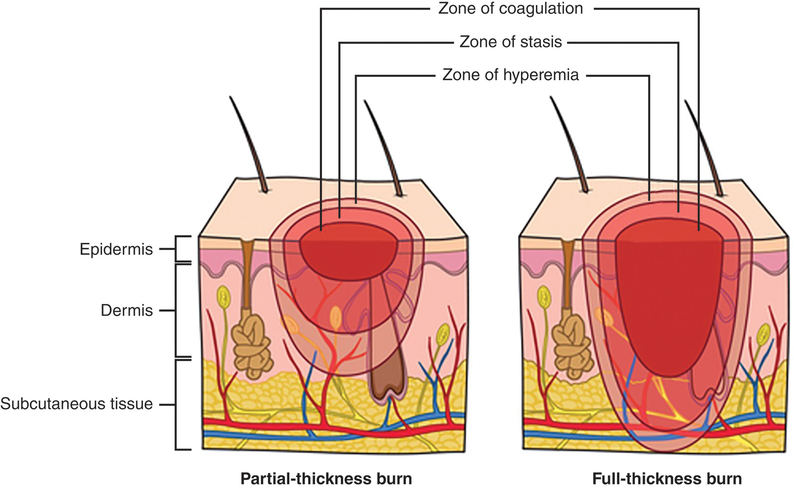 A diagram illustrates two types of skin injury: a partial thickness burn and a full thickness burn. Each injury is displayed in a cross-section of skin with three concentric areas of tissue damage. The diagram presents two cross-sectional illustrations of skin, one labeled as Partial thickness burn on the left and the other labeled as Full thickness burn on the right. Both illustrations show three layers of skin labeled Epidermis, Dermis, and Subcutaneous tissue, with blood vessels, nerves, and hair follicles visible in the deeper layers. A series of three brackets extends from the top of the diagram to both burn cross sections, labeling the concentric layers of injury as Zone of coagulation, Zone of stasis, and Zone of hyperemia, with the zone of coagulation being the deepest area of injury. The partial thickness burn extends into the dermis, while the full thickness burn extends into the subcutaneous tissue.