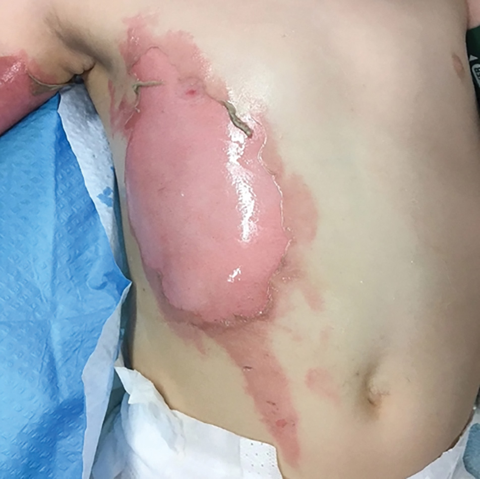 A photograph depicts a large, smooth, injured region. The injured area is irregularly shaped and extends from the right side chest toward the right abdomen. The skin is peeled from the surface layer.