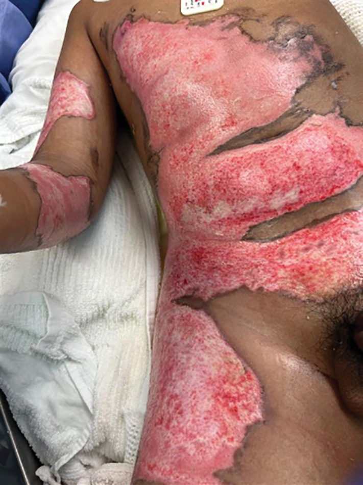 A photograph depicts the patient's torso and right arm with burned regions. The surface layer of the chest, abdomen exhibits large, irregular patches of injuries.