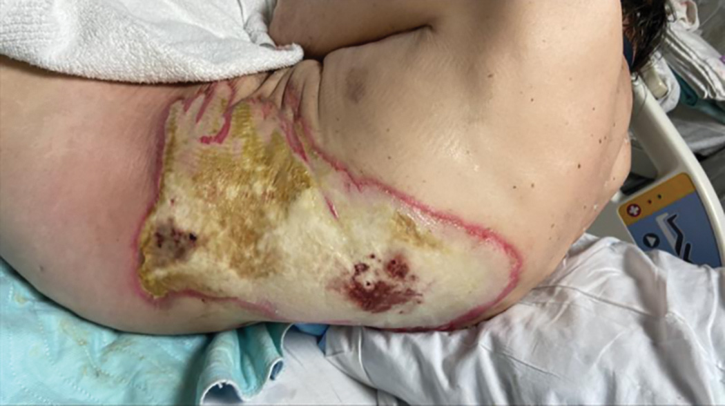A photograph presents a large wound on the patient's left flank. The wound is irregular in shape and covers a significant area of the side of the body, extending toward the back.