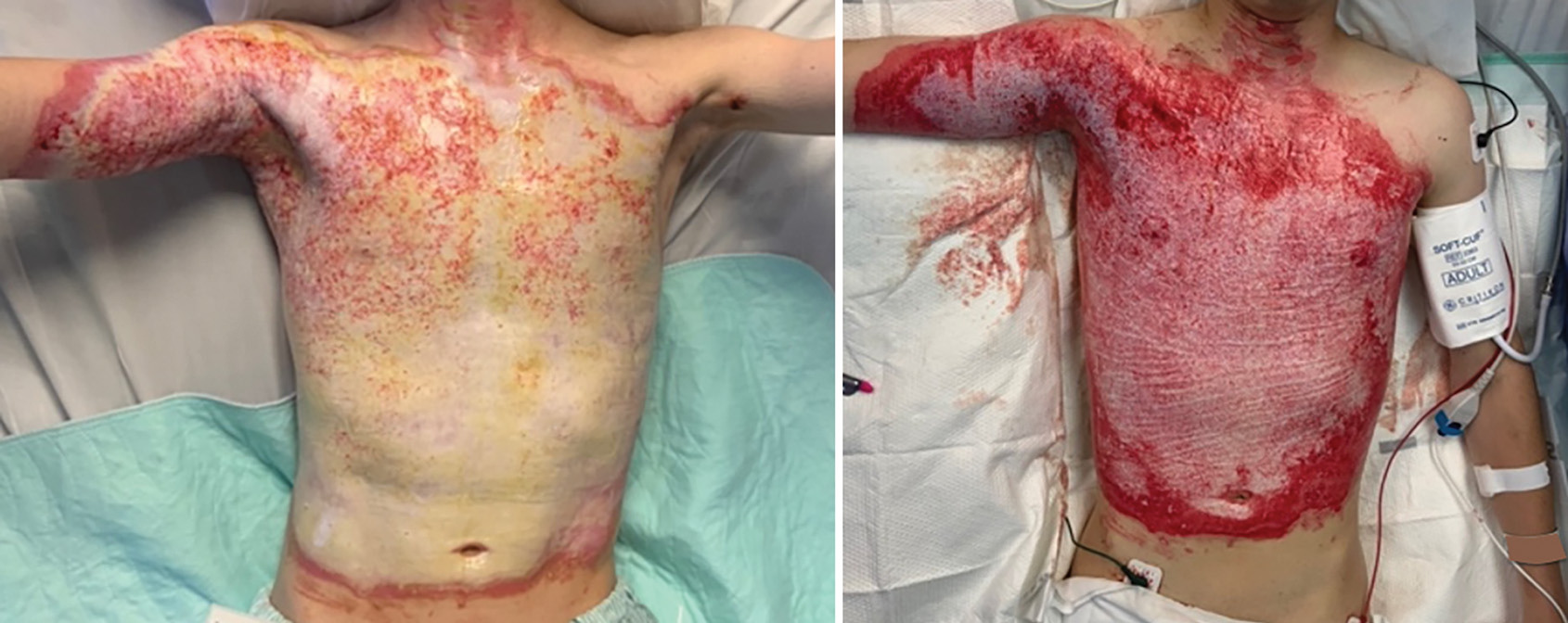 A pair of clinical photographs compares the wound on a patient's torso before and after the treatment. The pair of clinical photographs depicts the anterior view of a patient's torso. The patient is lying down with the upper body exposed, showing a wide area of injury across the shoulders, chest, and abdomen. The left illustration depicts the skin damage that appears patchy and extends onto the neck and arms. The right illustration depicts the patient's torso and right arm almost entirely covered with a thick application of topical material, while the patient is also connected to medical tubes and has a blood pressure cuff on the left arm.