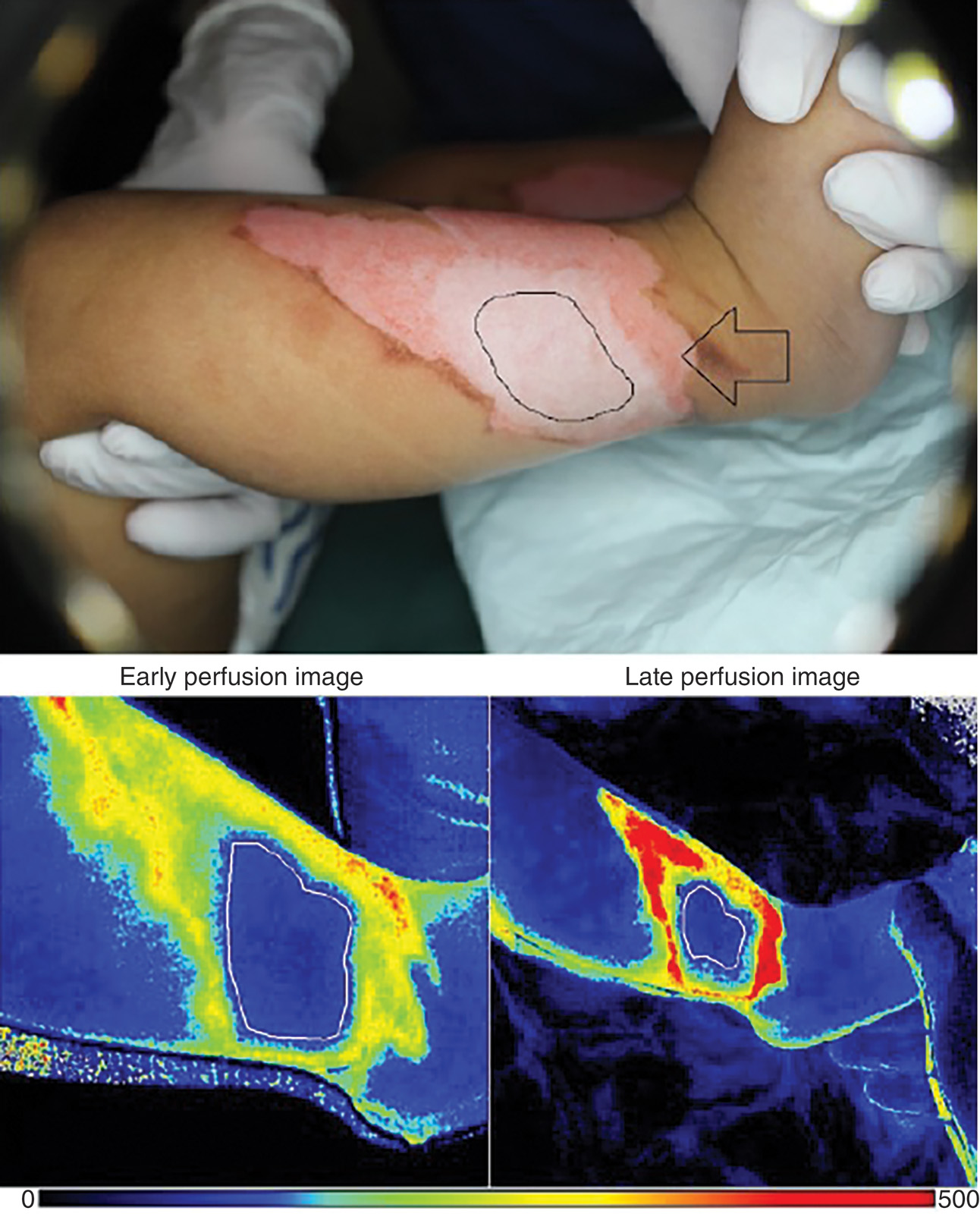 A set of three panels includes a photo and two perfusion panels. The clinical photograph at the top depicts a limb with a skin wound. The bottom panel depicts an early perfusion and a late perfusion. The set of three illustrations arranged in two rows shows a wound on a limb and corresponding perfusion panels. The top panel depicts gloved hands holding a limb showing a large burn area on the skin with a central irregular area outlined by a solid line. An arrow points to a small area adjacent to the burn. The bottom panels involve laser speckle views. The bottom left panel is an early perfusion panel that displays variations in flow across the wound area. The bottom right panel is a late perfusion panel showing changes in flow patterns over time. A linear scale is located at the bottom of the lower panel, reads 0 to 500.