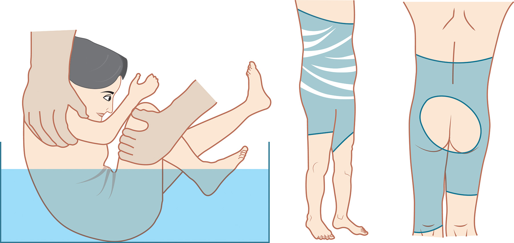 A set of three illustrations of a person immersed in a tub of liquid, lower torso and legs with a wrapped garment, and a back view of the body from shoulders to knees with wrapped material. The three illustrations depict an immersion scald injury. The leftmost panel depicts a person submerged in liquid up to the chest level, held by two hands, with the person's limbs flexed. The center panel is a side view of a lower torso and legs covered in a tight garment, with several curved lines across the upper thigh and hip area indicating areas of sparing or protection. The rightmost panel is a posterior view of the same lower torso and legs, also covered in a tight garment, with an open circular area visible over the buttocks.