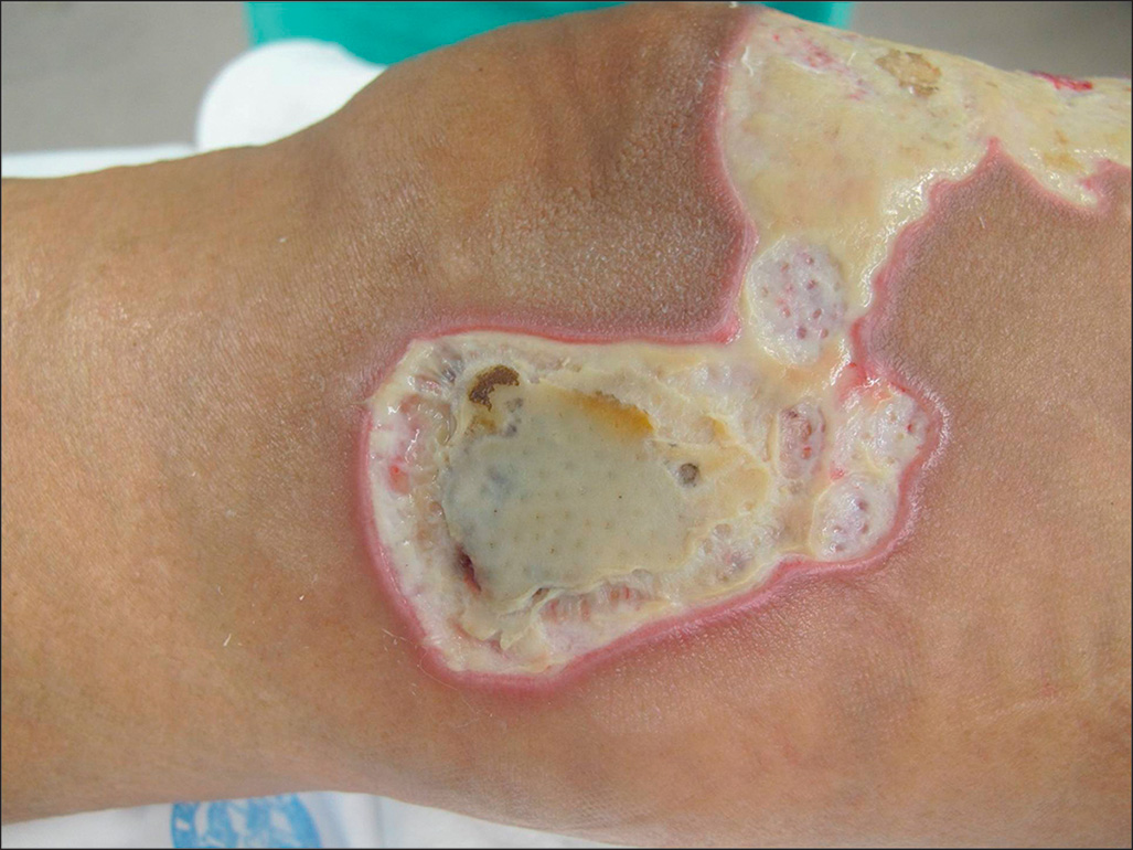A capture of the left medial knee depicts a large, damaged patch surrounded by a slightly elevated border. Multiple shallow erosions within the inflamed border, and the surrounding skin is intact.
