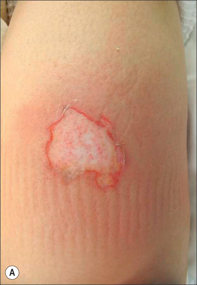 A pair of photos of the scald burn on the thigh, labeled A and B, with an erythema in the center of both views. Panel A shows inflamed skin. Panel B shows a healed skin region.
