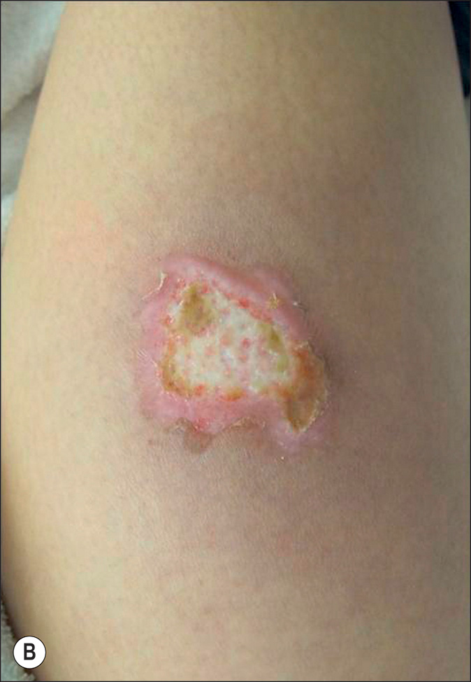A pair of photos of the scald burn on the thigh, labeled A and B, with an erythema in the center of both views. Panel A shows inflamed skin. Panel B shows a healed skin region.