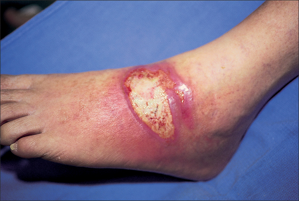A photo of a left foot and ankle with a burn wound exposing the internal layer. The wound has an irregular shape with a central area of tissue damage, and the surrounding skin is intact.