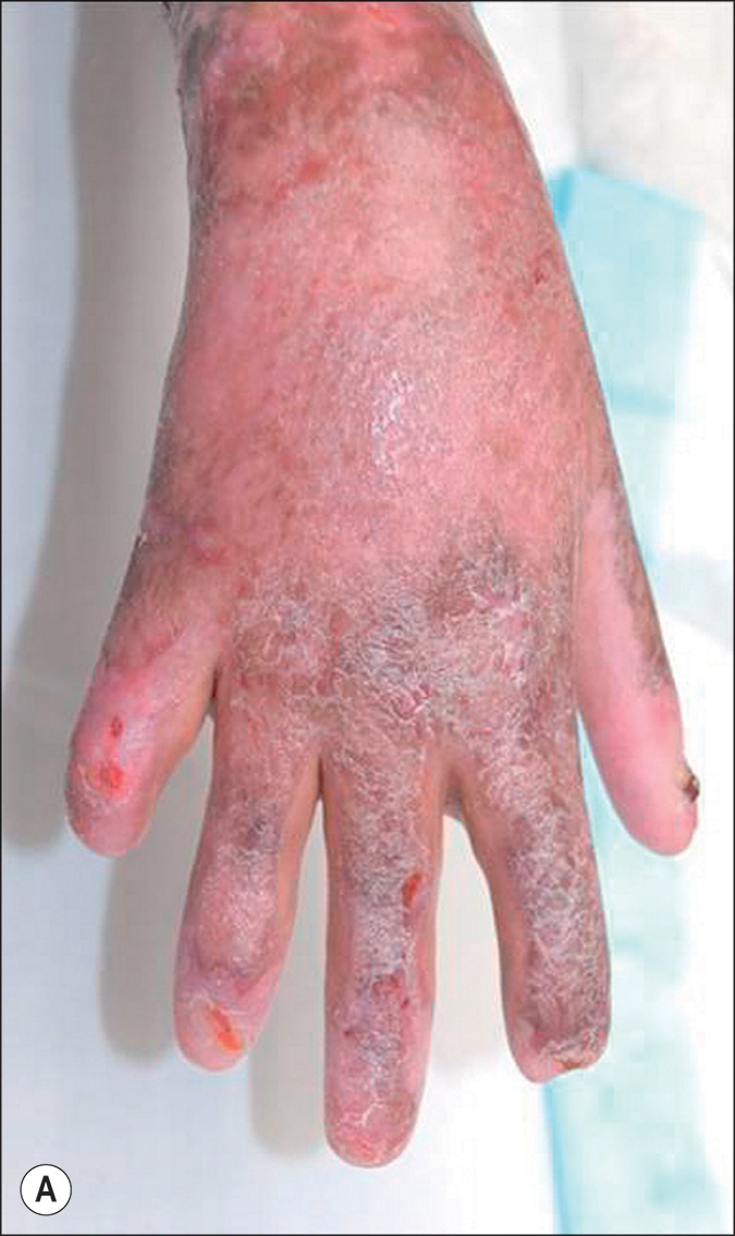 A pair of photographs labeled A and B depicts the burnt skin on the right hand. The skin is dry, scaly, and damaged, with some raw areas on the knuckles and fingers. The two photographs depict a burnt wound on the skin on the dorsal region of the hand and wrist, labeled A and B. Photograph A depicts the skin with a dry, rough texture, areas of peeling and cracking, and some darker spots near the base of the fingers. Photograph B depicts a more widespread, swollen, eroded, weepy appearance covering the entire external portion of the hand and extending onto the lower forearm.