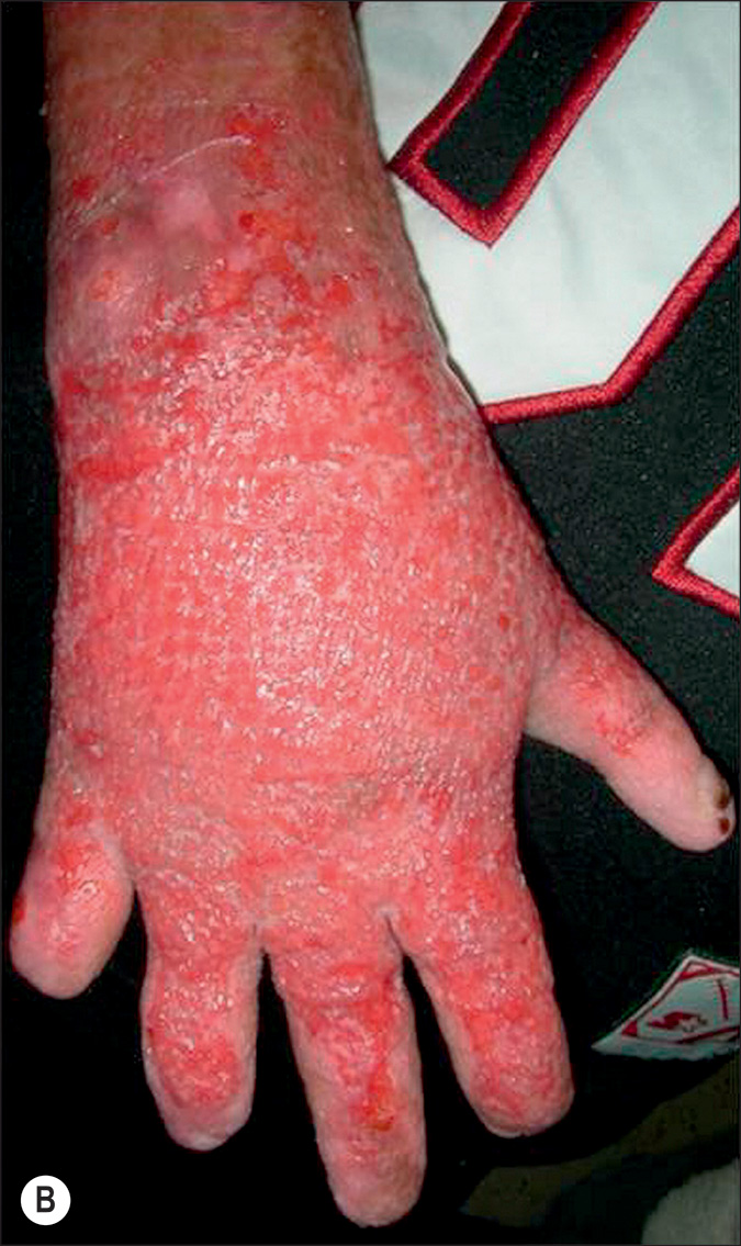 A pair of photographs labeled A and B depicts the burnt skin on the right hand. The skin is dry, scaly, and damaged, with some raw areas on the knuckles and fingers. The two photographs depict a burnt wound on the skin on the dorsal region of the hand and wrist, labeled A and B. Photograph A depicts the skin with a dry, rough texture, areas of peeling and cracking, and some darker spots near the base of the fingers. Photograph B depicts a more widespread, swollen, eroded, weepy appearance covering the entire external portion of the hand and extending onto the lower forearm.