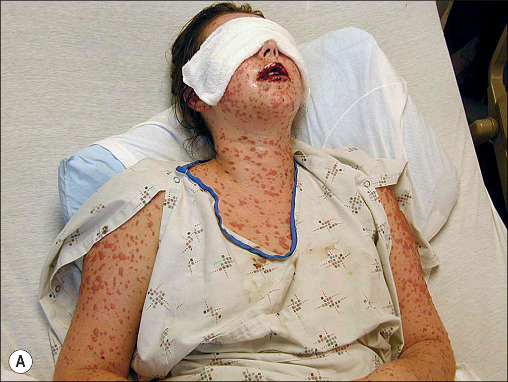 A pair of photographs depicts a cutaneous rash on a patient's body and two microscopic views of a tissue labeled A and B. Panels A and B show a person with numerous blisters on the face and neck. The set of four panels involves two photographs with cutaneous rashes and two microscopic views of rashes labeled A, B, C, and D, arranged in a two-by-two grid. The upper left panel labeled A depicts a photograph of a person lying with a bandage over the eyes, displaying numerous widespread rashes on the surface area of the body. The upper right panel, labeled B, depicts a photograph of the same person with a close-up view of the lesions in the mouth area, illustrating raw, crusted blisters on the lips, cheeks, and surrounding skin. The lower left panel, labeled C, depicts a microscopic view of a tissue with numerous tiny dot-like, cellular structures forming a border in the upper layer. A single multinucleated cell appears in the upper region. A fibrous structure is shown in the middle region. The lower right panel, labeled D, depicts a microscopic view of a tissue with epidermal and dermal layers, highlighting the detachment of the top layer and the presence of numerous round and elongated cellular structures within the lower dermal layer. The middle empty region separates the upper and lower regions. The lower region has nucleated cells that are loosely arranged along the section.