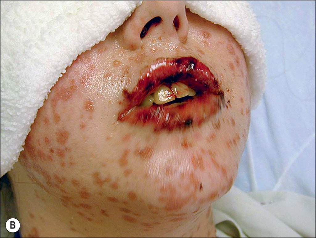 A pair of photographs depicts a cutaneous rash on a patient's body and two microscopic views of a tissue labeled A and B. Panels A and B show a person with numerous blisters on the face and neck. The set of four panels involves two photographs with cutaneous rashes and two microscopic views of rashes labeled A, B, C, and D, arranged in a two-by-two grid. The upper left panel labeled A depicts a photograph of a person lying with a bandage over the eyes, displaying numerous widespread rashes on the surface area of the body. The upper right panel, labeled B, depicts a photograph of the same person with a close-up view of the lesions in the mouth area, illustrating raw, crusted blisters on the lips, cheeks, and surrounding skin. The lower left panel, labeled C, depicts a microscopic view of a tissue with numerous tiny dot-like, cellular structures forming a border in the upper layer. A single multinucleated cell appears in the upper region. A fibrous structure is shown in the middle region. The lower right panel, labeled D, depicts a microscopic view of a tissue with epidermal and dermal layers, highlighting the detachment of the top layer and the presence of numerous round and elongated cellular structures within the lower dermal layer. The middle empty region separates the upper and lower regions. The lower region has nucleated cells that are loosely arranged along the section.